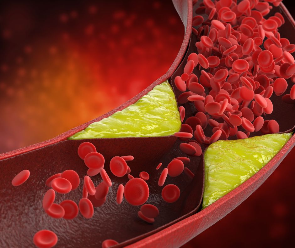 Ateroskleróza sa vyvíja pomaly, pretože cholesterol, tuk, krvinky a iné látky v krvi tvoria plak.