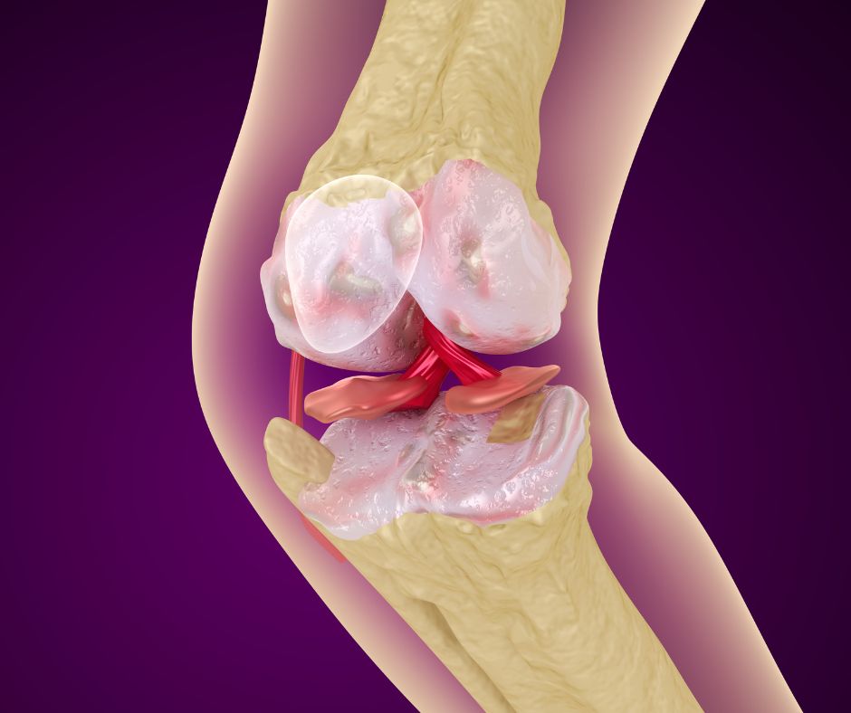 Zlomenina je často prvým príznakom osteoporózy.