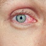 Jar je krásne obdobie, keď príroda ožíva – kvitnú stromy, kvety a trávy. Pre mnohých z nás je to čas radosti a dlhých prechádzok vonku. Pre alergikov však môže byť jar obdobím slzenia, pálenia a štípania očí. Prečo sa tieto príznaky objavujú a ako si uľaviť?